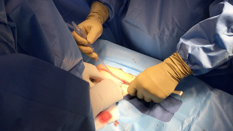 four tips for easy postpartum tubal ligation